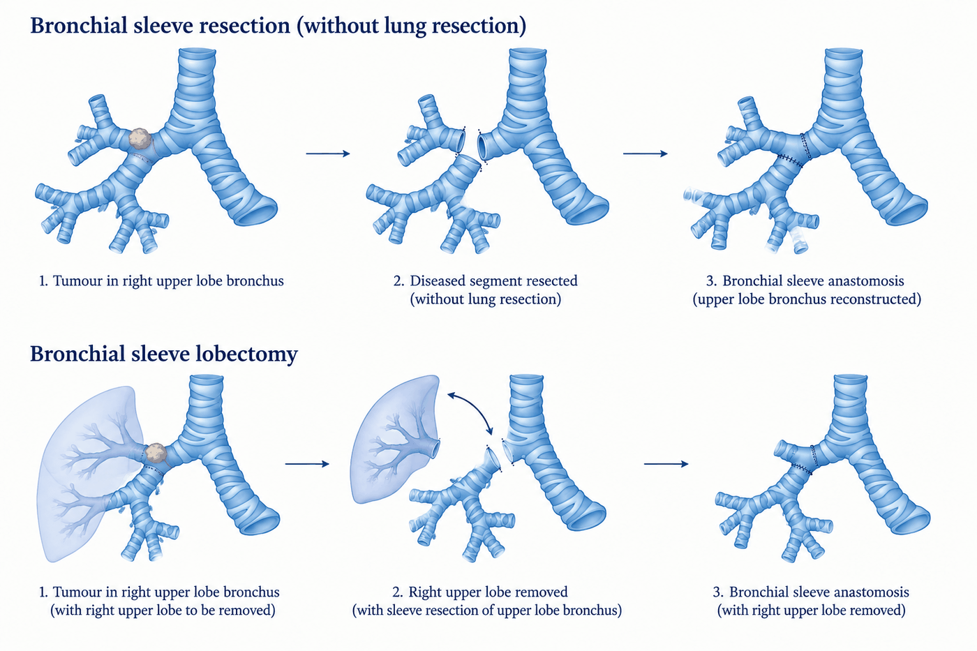 Diagram of bronchial sleeve resection without lung resection and bronchial sleeve lobectomy, each shown in three stages: tumour in the right upper lobe bronchus, resection of the diseased segment, and bronchial sleeve anastomosis