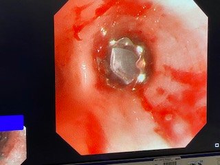 Endobronchial valve bronchoscopic view — Mr Lawrence Okiror