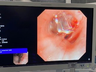 Endobronchial valve deployed bronchoscopically — Mr Lawrence Okiror